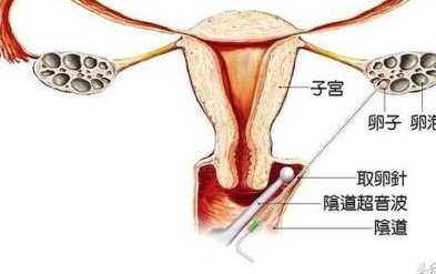 美国第三代试管婴儿多少钱？充满有用的信息