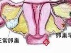 疤痕子宫能做试管婴儿吗？教你选择适合的试管方案